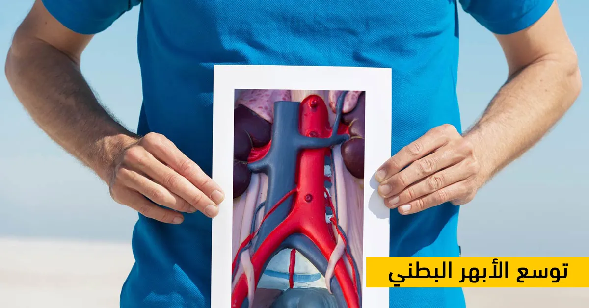 توسع الأبهر البطني